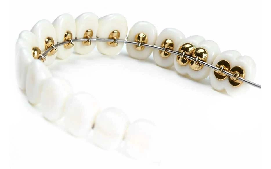 clinicadoctormahdi, Aparatul dentar incognito aur