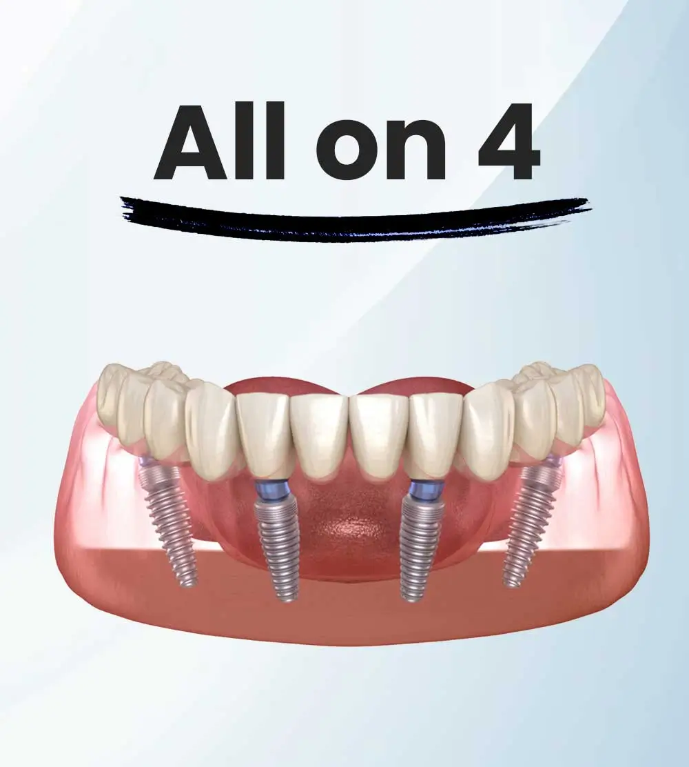 clinicadoctormahdi, Tratamente stomatologice, aparate dentare, dinti ficsi in 24 ore